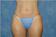 Liposuction After Photo by George John Alexander, MD, FACS; ,  - Case 36129