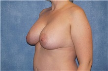 Mommy Makeover After Photo by George John Alexander, MD, FACS; ,  - Case 36130
