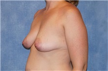 Mommy Makeover Before Photo by George John Alexander, MD, FACS; ,  - Case 36130
