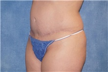 Mommy Makeover After Photo by George John Alexander, MD, FACS; ,  - Case 36130