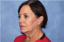 Facelift Before Photo by George John Alexander, MD, FACS; ,  - Case 36774