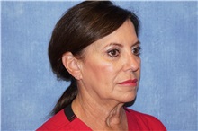 Facelift Before Photo by George John Alexander, MD, FACS; ,  - Case 36774