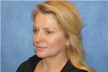 Facelift Before Photo by George John Alexander, MD, FACS; ,  - Case 36776
