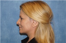 Facelift After Photo by George John Alexander, MD, FACS; ,  - Case 36776
