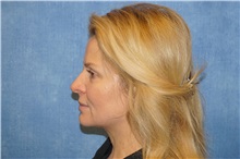 Facelift Before Photo by George John Alexander, MD, FACS; ,  - Case 36776