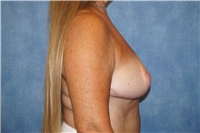 Breast Reduction After Photo by George John Alexander, MD, FACS; ,  - Case 36777