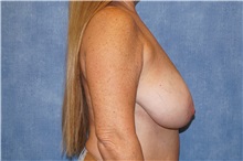 Breast Reduction Before Photo by George John Alexander, MD, FACS; ,  - Case 36777