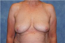 Breast Implant Removal After Photo by George John Alexander, MD, FACS; ,  - Case 36782