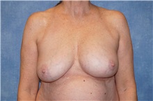 Breast Implant Removal Before Photo by George John Alexander, MD, FACS; ,  - Case 36782
