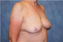 Breast Implant Removal After Photo by George John Alexander, MD, FACS; ,  - Case 36782