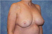 Breast Implant Removal Before Photo by George John Alexander, MD, FACS; ,  - Case 36782