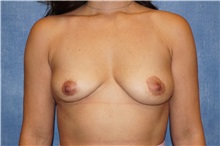 Breast Implant Removal After Photo by George John Alexander, MD, FACS; Las Vegas, NV - Case 36783
