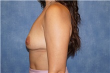 Breast Implant Removal After Photo by George John Alexander, MD, FACS; Las Vegas, NV - Case 36783