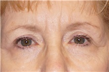 Eyelid Surgery After Photo by George John Alexander, MD, FACS; ,  - Case 36788