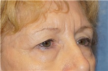 Eyelid Surgery Before Photo by George John Alexander, MD, FACS; ,  - Case 36788