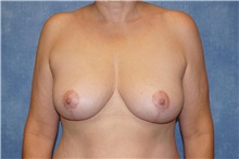 Breast Lift After Photo by George John Alexander, MD, FACS; Las Vegas, NV - Case 36789