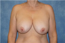 Breast Lift Before Photo by George John Alexander, MD, FACS; Las Vegas, NV - Case 36789