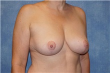 Breast Lift After Photo by George John Alexander, MD, FACS; Las Vegas, NV - Case 36789