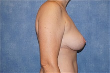 Breast Lift After Photo by George John Alexander, MD, FACS; Las Vegas, NV - Case 36789