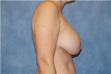 Breast Lift Before Photo by George John Alexander, MD, FACS; Las Vegas, NV - Case 36789