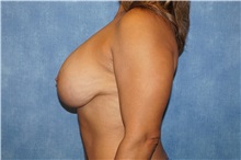 Breast Lift After Photo by George John Alexander, MD, FACS; Las Vegas, NV - Case 36795