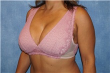 Breast Lift After Photo by George John Alexander, MD, FACS; Las Vegas, NV - Case 36795