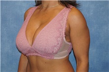 Breast Lift Before Photo by George John Alexander, MD, FACS; Las Vegas, NV - Case 36795