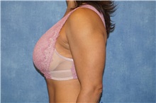 Breast Lift Before Photo by George John Alexander, MD, FACS; Las Vegas, NV - Case 36795