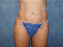 Liposuction After Photo by George John Alexander, MD, FACS; Las Vegas, NV - Case 36799
