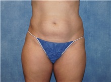 Liposuction Before Photo by George John Alexander, MD, FACS; Las Vegas, NV - Case 36799