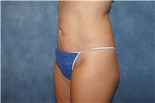 Liposuction After Photo by George John Alexander, MD, FACS; ,  - Case 36799
