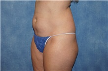 Liposuction Before Photo by George John Alexander, MD, FACS; ,  - Case 36799