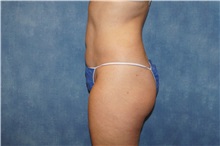 Liposuction After Photo by George John Alexander, MD, FACS; ,  - Case 36799