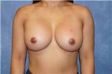 Breast Augmentation After Photo by George John Alexander, MD, FACS; ,  - Case 36800