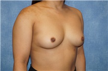 Breast Augmentation Before Photo by George John Alexander, MD, FACS; ,  - Case 36800