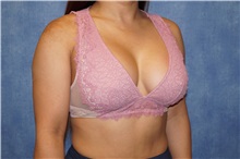 Breast Augmentation After Photo by George John Alexander, MD, FACS; ,  - Case 36800