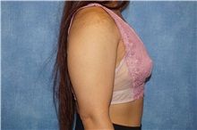 Breast Augmentation Before Photo by George John Alexander, MD, FACS; ,  - Case 36800