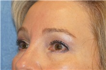 Brow Lift After Photo by George John Alexander, MD, FACS; ,  - Case 37544