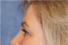 Brow Lift Before Photo by George John Alexander, MD, FACS; ,  - Case 37544