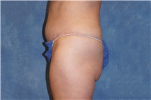 Tummy Tuck After Photo by George John Alexander, MD, FACS; ,  - Case 37545