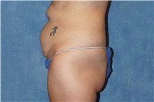 Tummy Tuck Before Photo by George John Alexander, MD, FACS; ,  - Case 37545