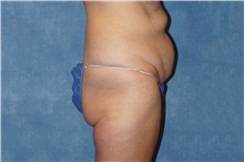 Tummy Tuck After Photo by George John Alexander, MD, FACS; ,  - Case 37545