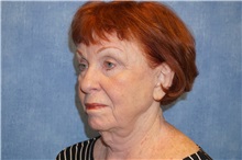 Facelift After Photo by George John Alexander, MD, FACS; ,  - Case 37839
