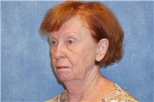 Facelift Before Photo by George John Alexander, MD, FACS; ,  - Case 37839