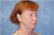 Facelift Before Photo by George John Alexander, MD, FACS; ,  - Case 37839
