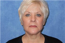 Facelift After Photo by George John Alexander, MD, FACS; ,  - Case 37840