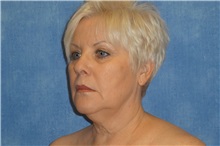 Facelift Before Photo by George John Alexander, MD, FACS; ,  - Case 37840