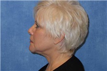 Facelift After Photo by George John Alexander, MD, FACS; ,  - Case 37840