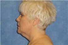 Facelift Before Photo by George John Alexander, MD, FACS; ,  - Case 37840