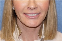 Facelift After Photo by George John Alexander, MD, FACS; ,  - Case 37841